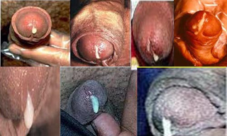 Illustration for article titled Obat Lubang Penis Bengkak Merah dan Keluar Nanah
